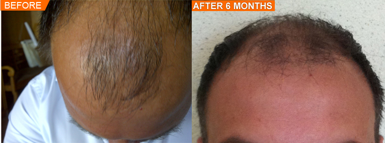 MaxRoot Hair Growth, no dandruff